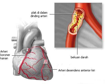 Aterosklerosis