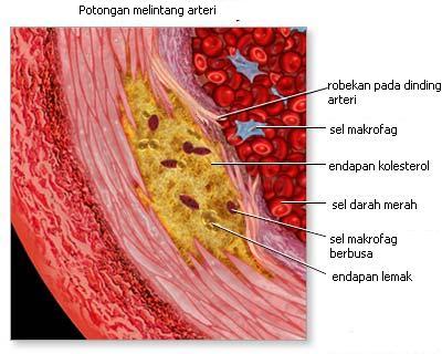 Aterosklerosis