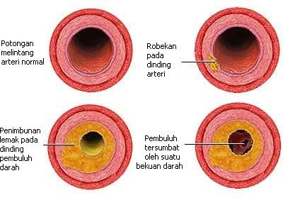 Aterosklerosis