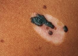 Melanoma
