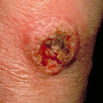 Squamous cell carcinoma