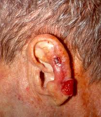 Basal cell carcinoma cancer