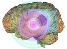 Kanker Otak - Brain Cancer