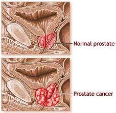 kanker prostat