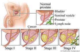 Prostatektomi radikal